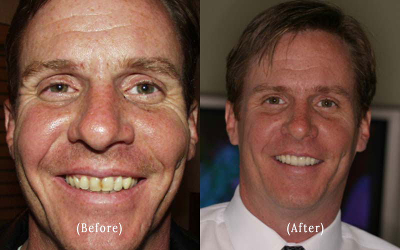 Porcelain Veneers before & after 11