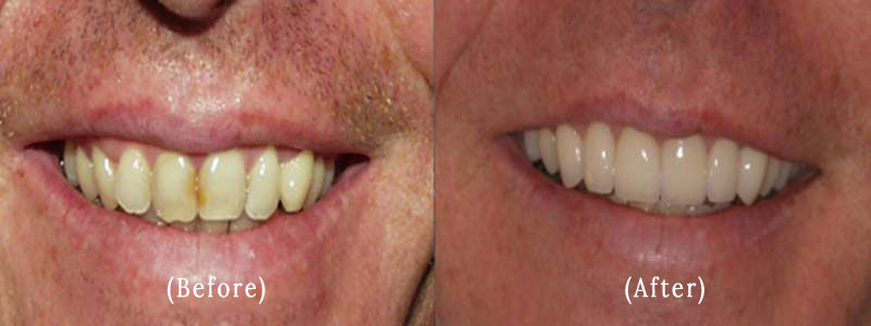 Porcelain Veneers before & after 14