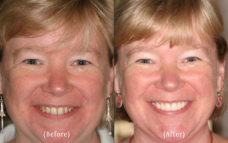 Porcelain Veneers before & after 8