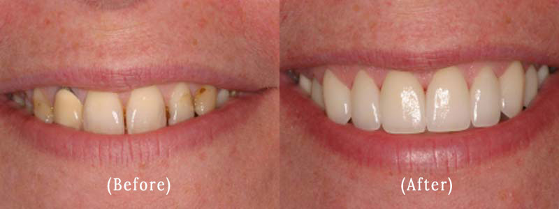 Porcelain Veneers before & after 10