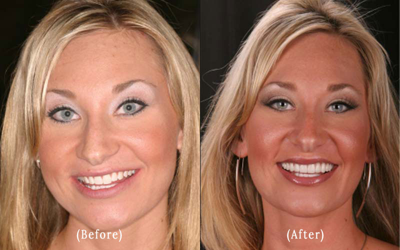 Porcelain Veneers before & after 13