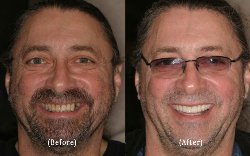 Dental Crowns And Bridge Work before & after 6