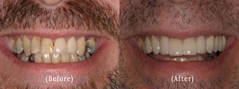 Dental Crowns And Bridge Work before & after 2