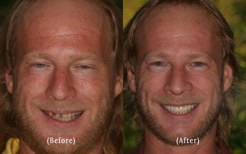 Dental Crowns And Bridge Work before & after 3
