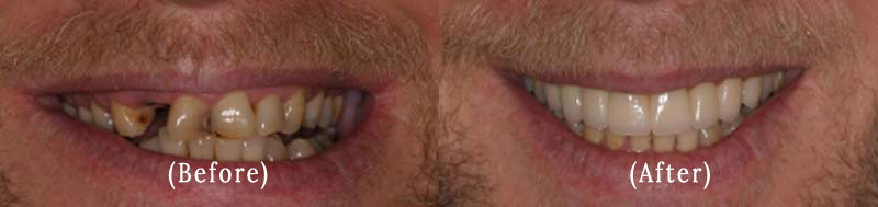 Dental Crowns And Bridge Work before & after 7