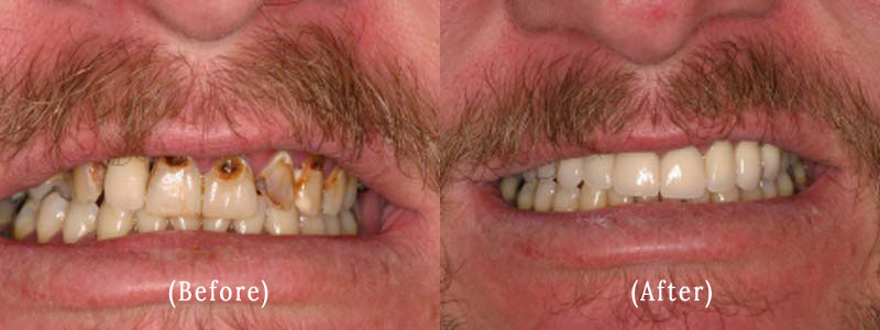 Dental Crowns And Bridge Work before & after