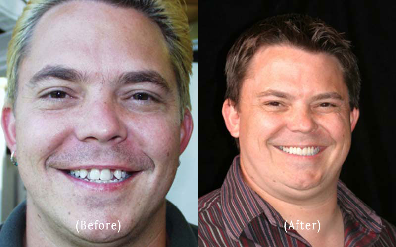Dental Crowns And Bridge Work before & after 5