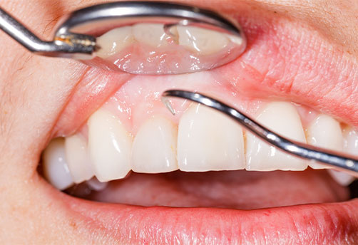 Gum disease