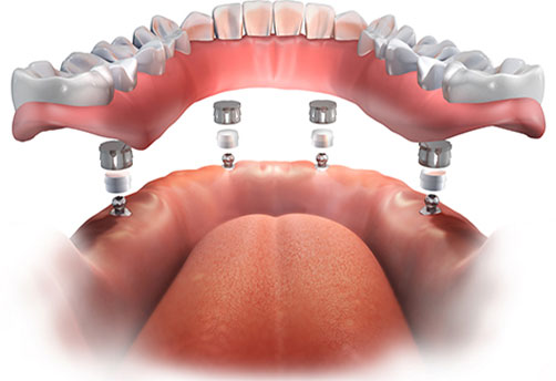 Implant supported denture