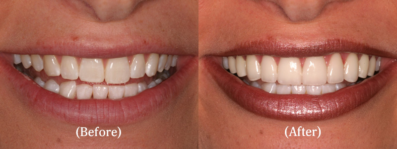 Porcelain Veneers before & after 12
