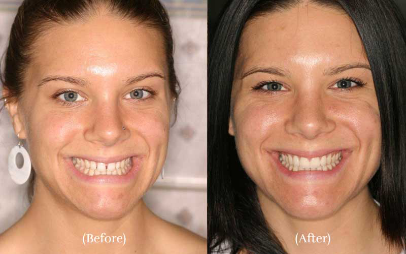 Minimal Prep Veneers 1