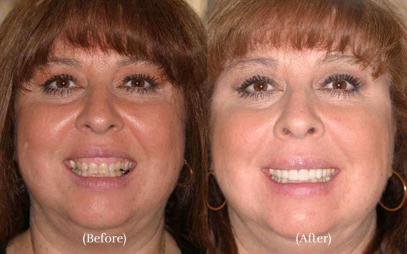 Porcelain Veneers 1