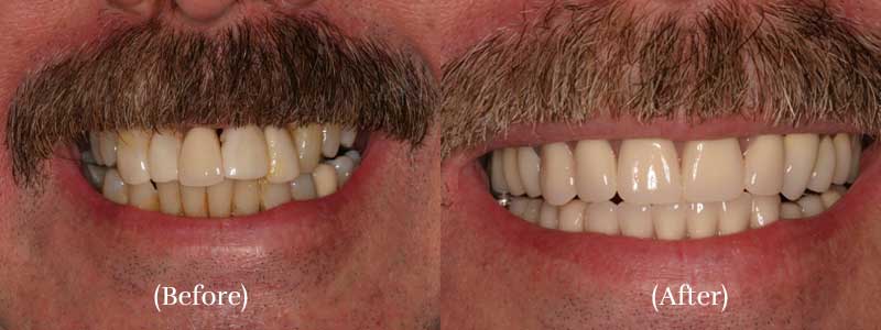 Smile Makeover before & after