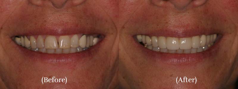 Porcelain Veneers before & after 3