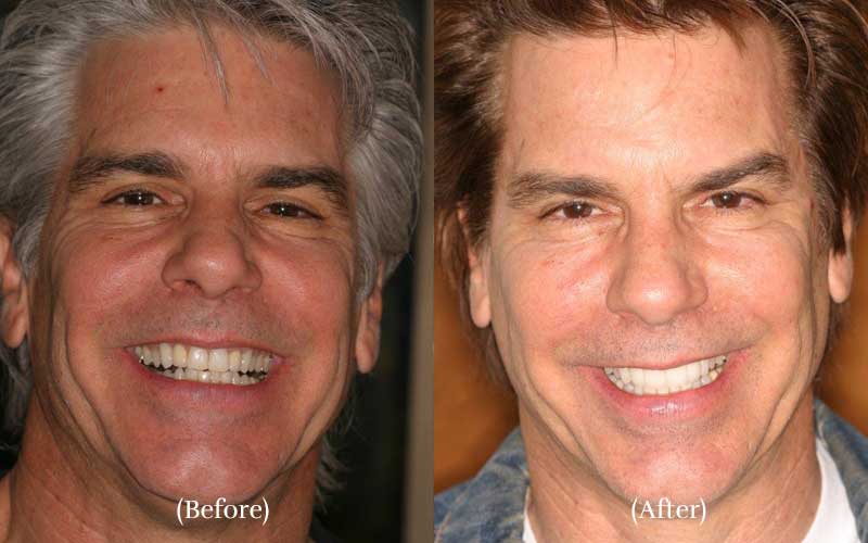 Upper & Lower Veneers before & after 2
