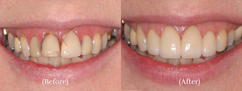 4 Veneers & Laser Tissue Contouring before & after 2