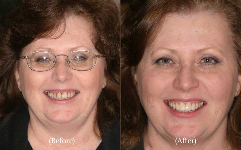 4 Veneers & Laser Tissue Contouring before & after