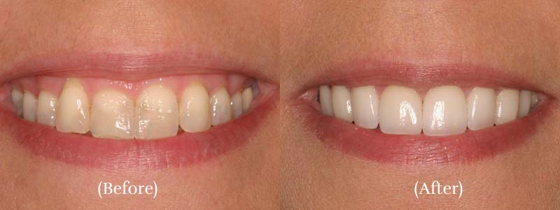 Veneers & Soft Tissue Laser Contouring before & after