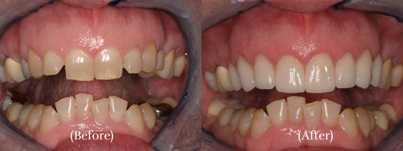 Upper 8 Porcelain Veneers before & after