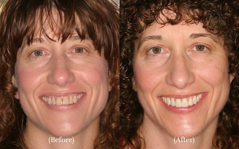 Veneers and Special Whitening before & after