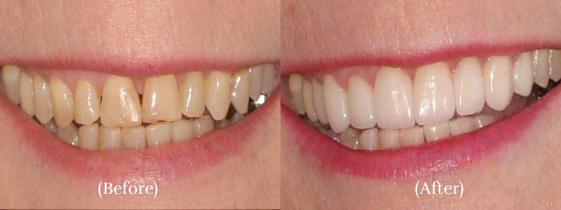 Porcelain Veneers before & after 5
