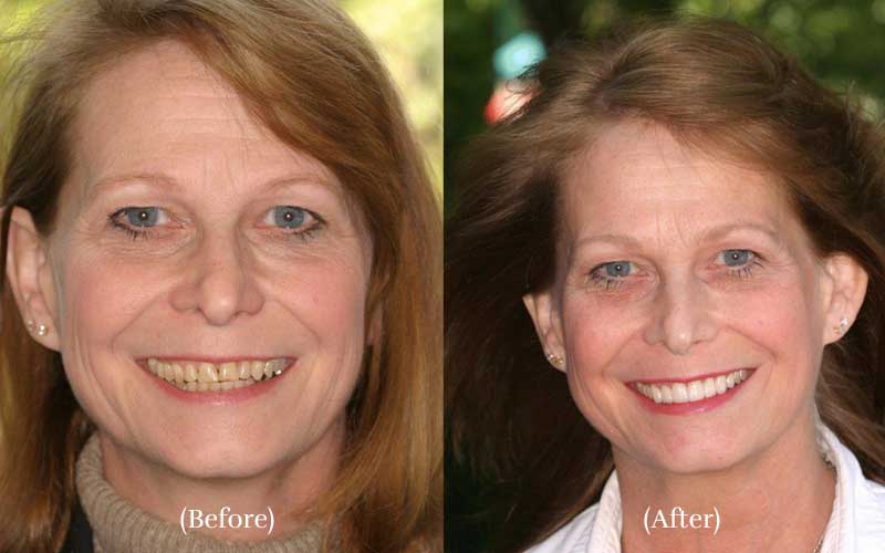 Porcelain Veneers before & after 2