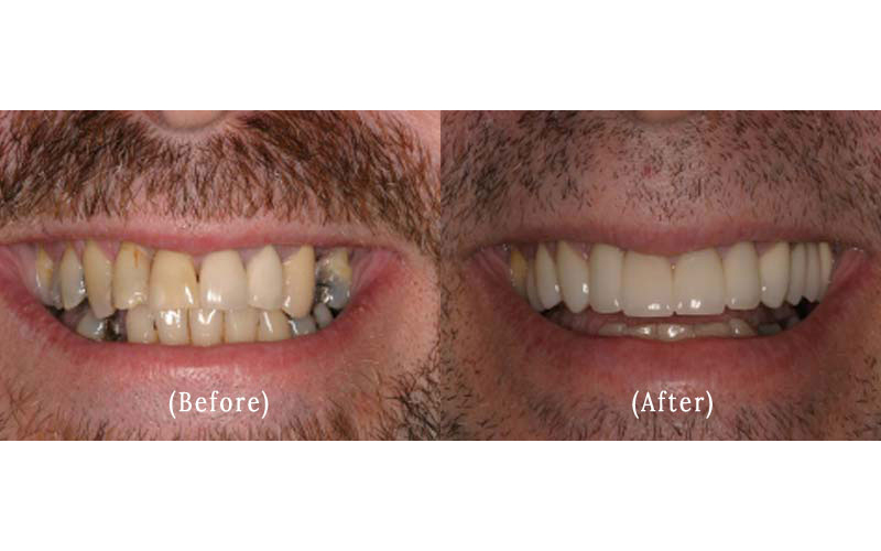Dental Crowns And Bridge Work before & after 6 Full Teeth