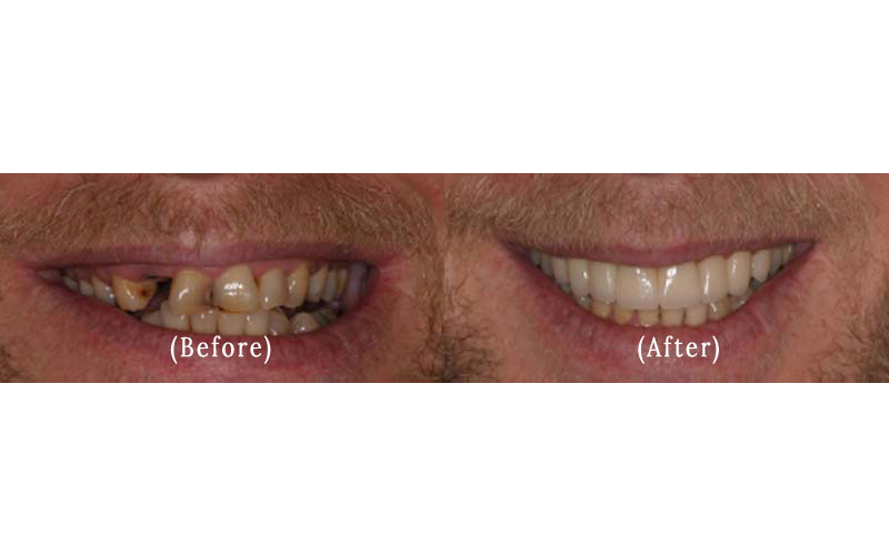Dental Crowns And Bridge Work before & after 3 Full Teeth