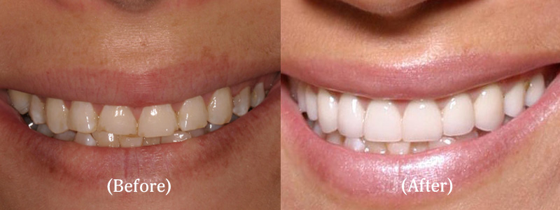 Porcelain Veneers before & after 17