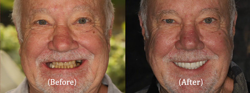 Full Implant-Supported Permanent Teeth, Full Face
