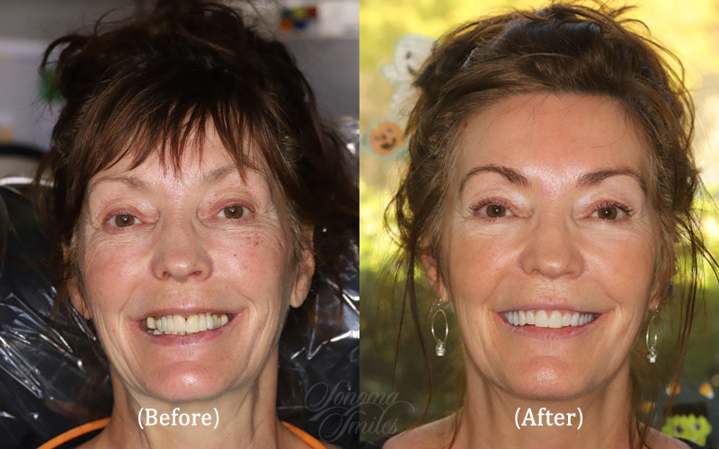 Full Upper Arch Reconstruction, Full Face