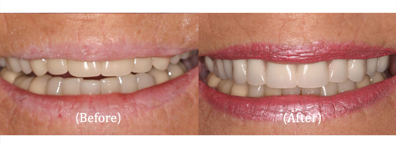 New Upper Fountain of Youth Cosmetic Denture