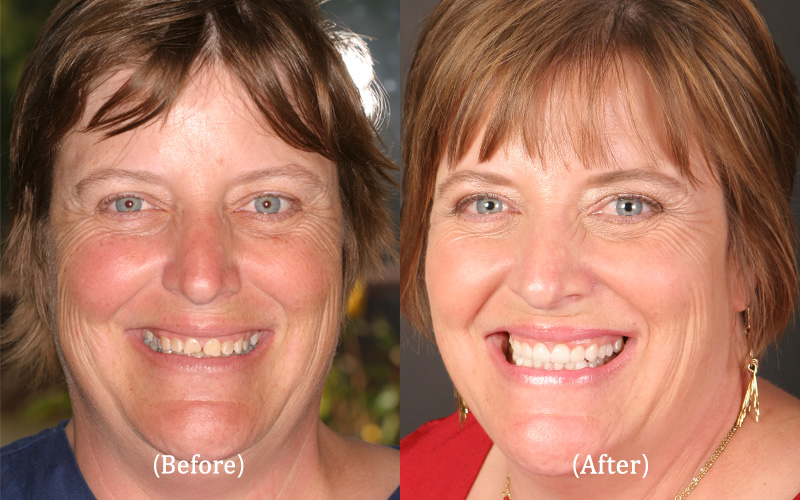 Upper and Lower Full Mouth Reconstruction – Winner of the 'Give Back a Smile' Program, Full Face