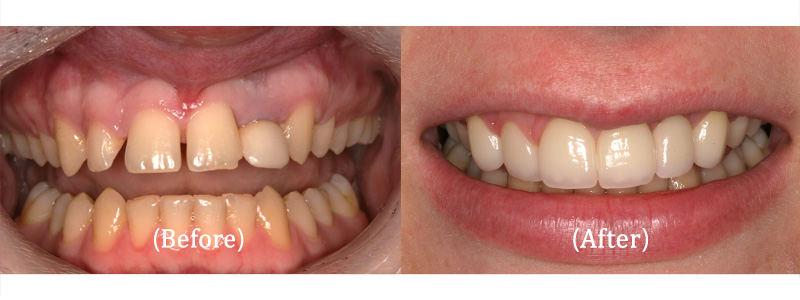 Upper Porcelain Crowns and Implant Restoration
