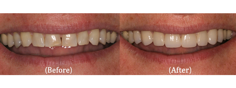Upper Smile Makeover with Veneers